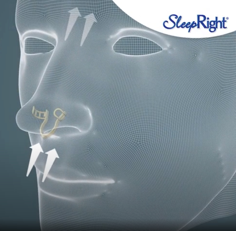 Dilatador nasal para respirar mejor, aliviar la congestión y reducir los  ronquidos, Férulas Dentales .NET - Cuidado y Salud Bucal